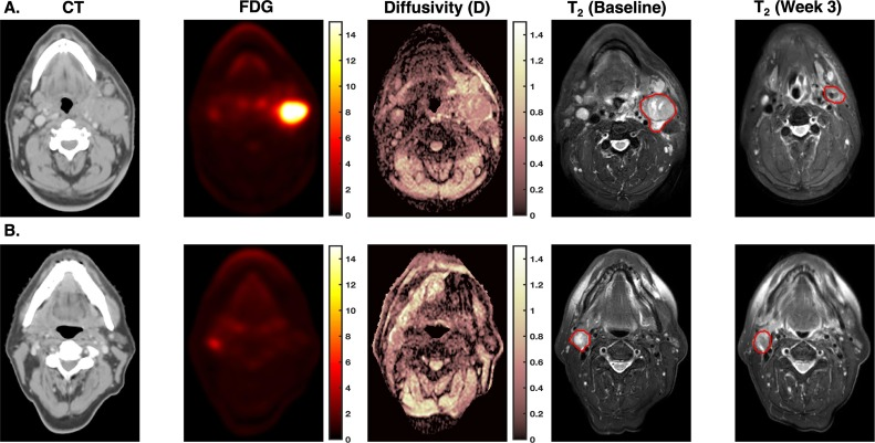 Memorial Sloan Kettering Radiation Oncology (@msk_radonc) on Twitter photo New in <a href="/PhiroTweets/">Phiro Tweets</a>:
Quantitative imaging metrics correlated with rapid volume loss during #radiotherapy for head & neck cancer #hncsm including high density/proliferation image markers. FDG #PET correlated with regression in uni/multivariate analysis.
phiro.science/article/S2405-… New in <a href="/PhiroTweets/">Phiro Tweets</a>:
Quantitative imaging metrics correlated with rapid volume loss during #radiotherapy for head & neck cancer #hncsm including high density/proliferation image markers. FDG #PET correlated with regression in uni/multivariate analysis.
phiro.science/article/S2405-…