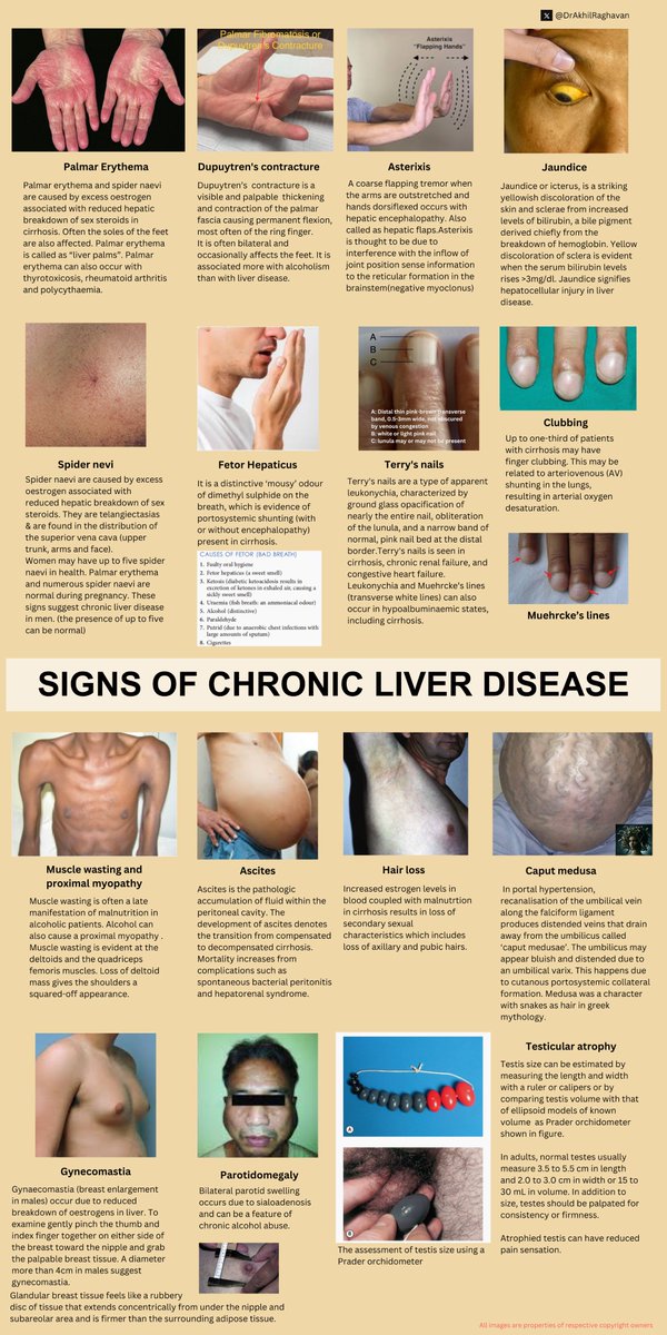 docakx's tweet photo. 🌟 Signs/Stigmata of chronic liver disease https://t.co/JqOsTLuV6i