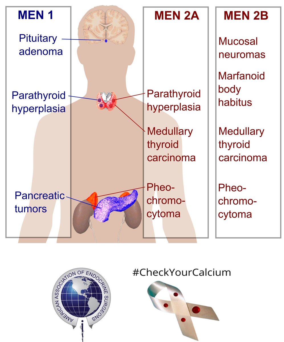 TheAAES's tweet image. Multiple Endocrine Neoplasia (MEN) is a genetic syndrome that affects multiple endocrine organs. Almost all patients with MEN1 develop primary hyperparathyroidism, compared to 20% of patients with MEN2a. #CheckYourCalcium #PAM2024 @TheAACE @ParaTroupers1 @TheEndoSociety
