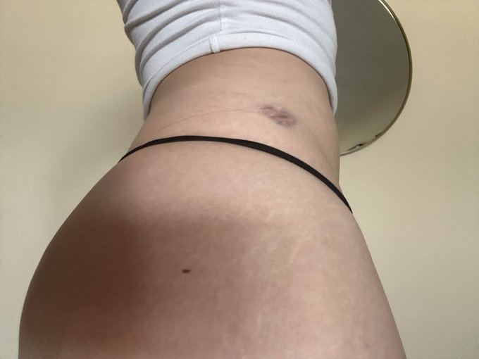 I have a 💜 shaped bruise 🥰  lol I have no idea how I got this https://t.co/l2IFdWkglX