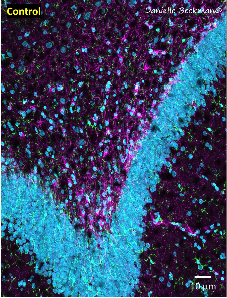DaniBeckman's tweet photo. Every #COVID infection is a risk for the brain because:
1- Ace2 receptor (entry receptor for SARS-Cov-2 in cells) is highly expressed in all blood vessels, including cerebral ones.
2- The virus arriving in the brain will cause a mess. Even if you don't look at infected cells, check the outcome of a viral infection. It is always neuroinflammation.
The images below show the hippocampal region (memory and cognition) with and without SARS-Cov-2. The staining is for glia cells (🟢microglia🟣astrocytes) and neurons (🔵). There is no staining for the virus in the image, but you can see where a large blood vessel arrived and the damage it caused to surrounding neurons. 
#CovidIsNotOver 
#NotjustaFLU