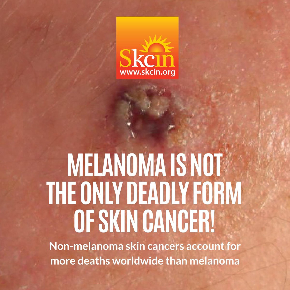 A study presented at the European Academy of Dermatology and Neurology Congress 2023 reported that there are now more global deaths from non-melanoma skin cancers than melanoma itself.