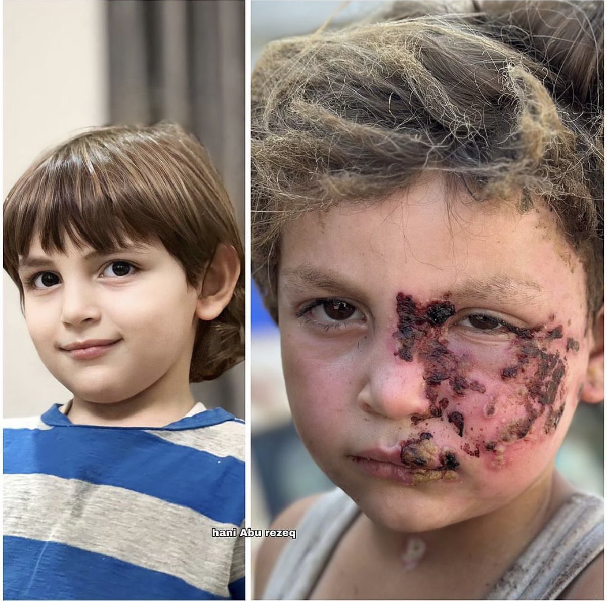 EyeonPalestine's tweet photo. The child Husni Weshah (5) face was injured, along with his hands and legs after the bombing of a school in Nusairat refugee camp. https://t.co/oY6s1lCLKx