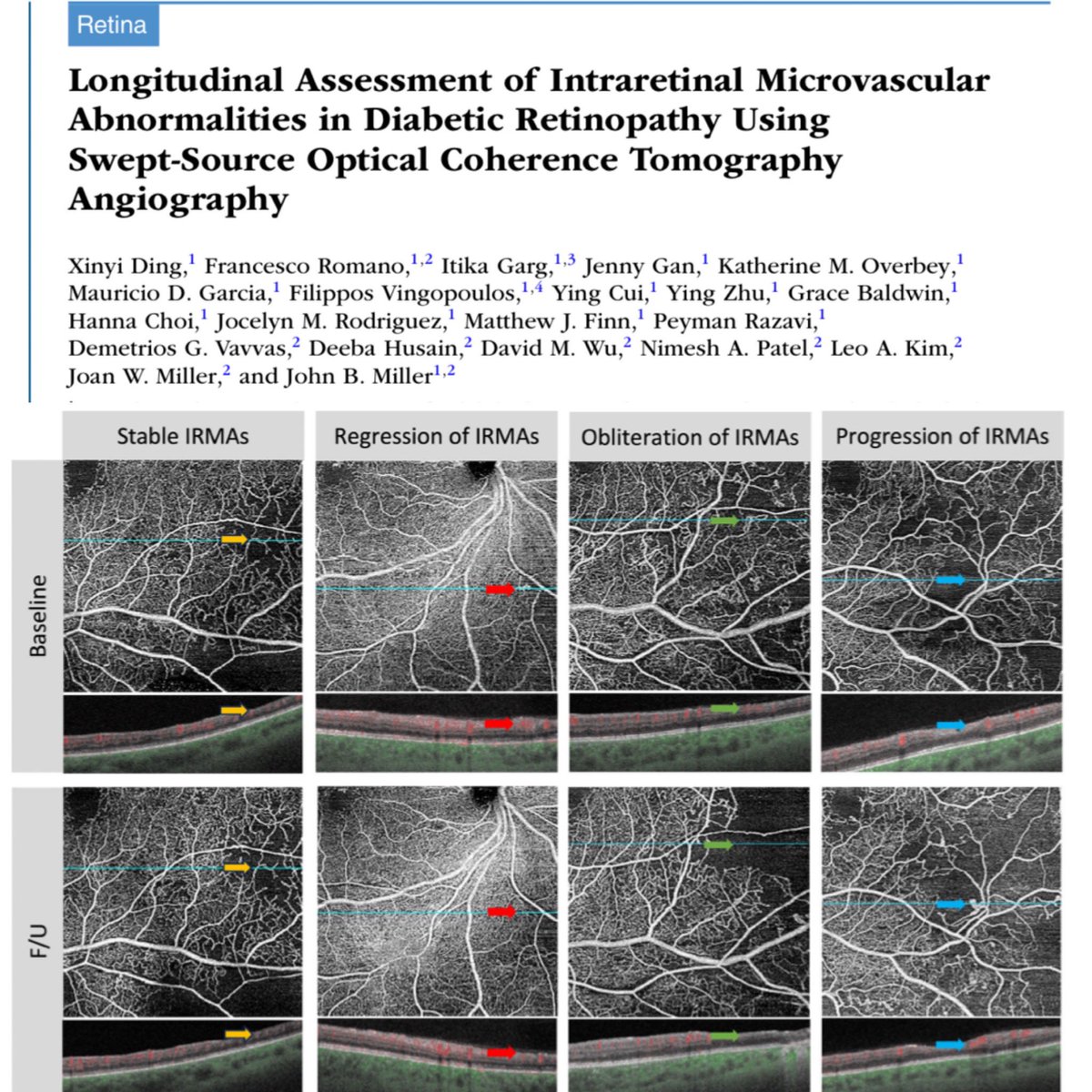 Itika Garg, MD (@itikagarg) on Twitter photo Thrilled to share our work on longitudinal #IRMA progression in patients with #DiabeticRetinopathy using #SSOCTA published in #IOVS <a href="/ARVOinfo/">ARVO</a> <a href="/JohnBMillerMD/">John B. Miller</a> <a href="/dngxny504976251/">Xinyi Ding</a> <a href="/HMSeye/">Harvard Ophthalmology</a> #HarvardRetinalImagingLab
iovs.arvojournals.org/article.aspx?a… Thrilled to share our work on longitudinal #IRMA progression in patients with #DiabeticRetinopathy using #SSOCTA published in #IOVS <a href="/ARVOinfo/">ARVO</a> <a href="/JohnBMillerMD/">John B. Miller</a> <a href="/dngxny504976251/">Xinyi Ding</a> <a href="/HMSeye/">Harvard Ophthalmology</a> #HarvardRetinalImagingLab
iovs.arvojournals.org/article.aspx?a…