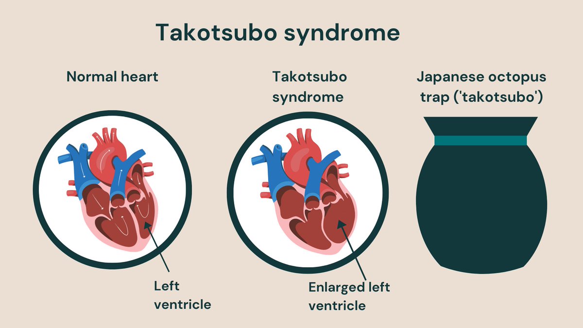 متلازمة القلب المنكسر (Broken heart syndrome)
أو ما يعرف أيضًا باعتلال تاكوتسوبو لعضلة القلب.
(takotsubo cardiomyopathy) التاكتسوبو هو وعاء ياباني فخاري له شكل فريد. وعندما نمر بخسارة شخص حبيب فإن قلوبنا تتأثر فيزيائيًا بذلك ليشبه البطين الأيسر الوعاء، ويهدد جودة حياتنا مستقبلا