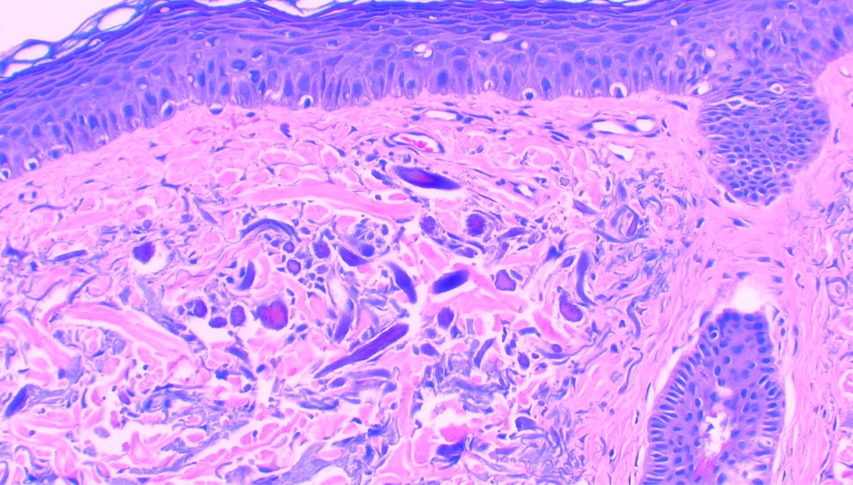 Int Soc Dermpath (@intsocdermpath) on Twitter photo #ISDP #Olympics
Spot diagnosis
Case 8 - <a href="/JCandidoXavier/">Jose Candido</a>
OCHRONOSIS
•Clinical presentation: blue–black cutaneous pigmentation
•Typical swollen, irregular, golden brown banana 🍌shaped, sickled or round ochronotic bodies
#dermpath #dermatology #pathology #path #ISDP #Olympics
Spot diagnosis
Case 8 - <a href="/JCandidoXavier/">Jose Candido</a>
OCHRONOSIS
•Clinical presentation: blue–black cutaneous pigmentation
•Typical swollen, irregular, golden brown banana 🍌shaped, sickled or round ochronotic bodies
#dermpath #dermatology #pathology #path