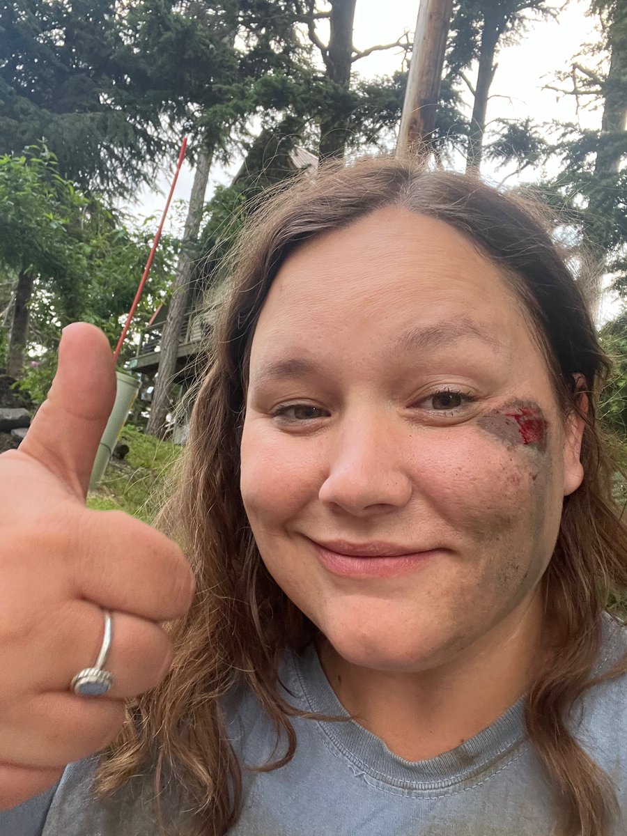 BrookeLavender's tweet photo. Always wear a helmet. July 1 I crashed my mountain bike with a helmet on, and still walked away with a gnarly concussion and a broken collarbone. About 1 in every 5 reported injuries in Alaska included a brain injury in a study from 2012-2016. https://t.co/nHUgiv4mpk