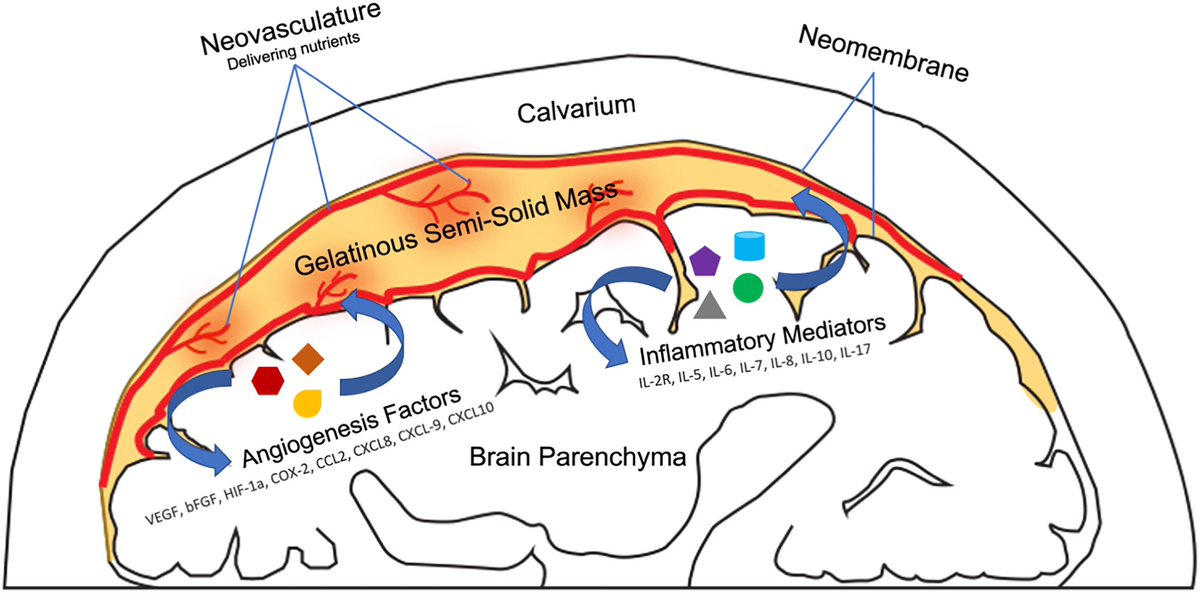 Chronic subdural hematoma: What precisely are we treating? journals.sagepub.com/doi/full/10.11…