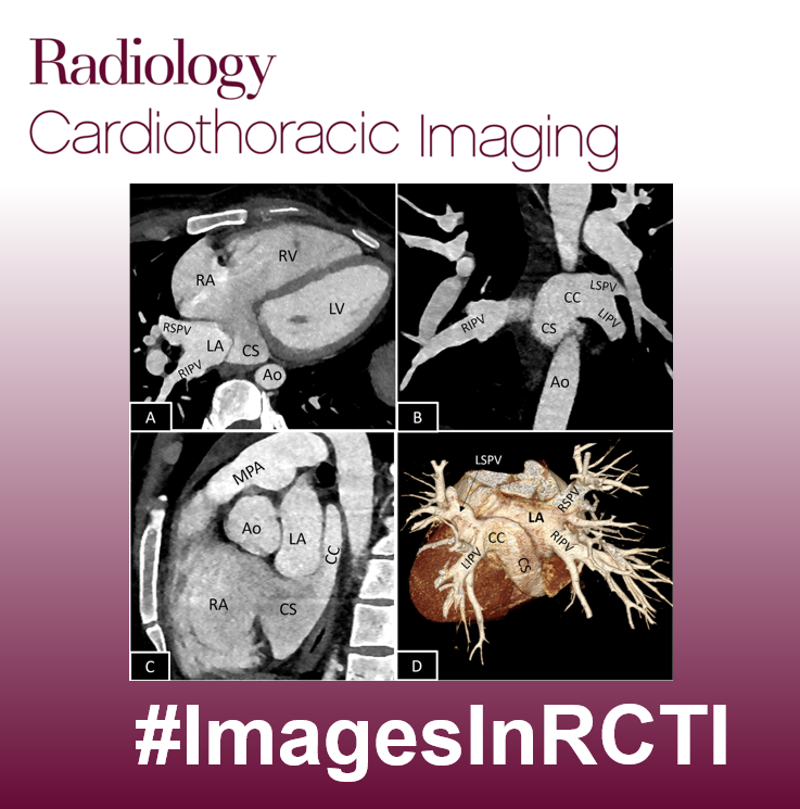 Jordan Chamberlin MD (@jordanc_md) on Twitter photo Up today we have another #InTrainingRCTI #ImagesInRCTI challenge highlighting a great case from <a href="/RadiologyCTI/">Radiology: Cardiothoracic Imaging</a>
1/2 31-year-old female presents with SOB and chest pain for two months. They have no relevant past medical history.
What is the diagnosis?
What are the findings? Up today we have another #InTrainingRCTI #ImagesInRCTI challenge highlighting a great case from <a href="/RadiologyCTI/">Radiology: Cardiothoracic Imaging</a>
1/2 31-year-old female presents with SOB and chest pain for two months. They have no relevant past medical history.
What is the diagnosis?
What are the findings?