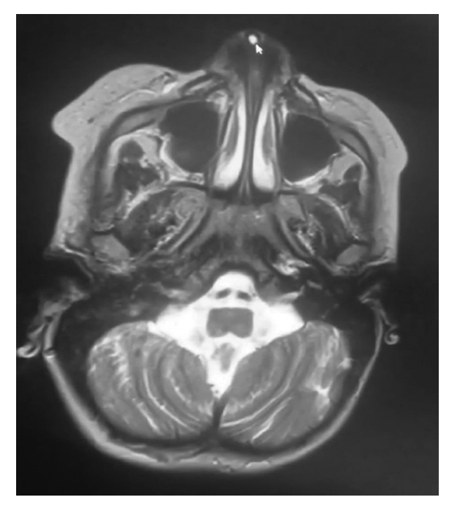 🌟New #Research: #Columella fistula: A case report 
By Sara Moujrid et al. 
Read it here #OpenAccess: doi.org/10.36922/td.25…