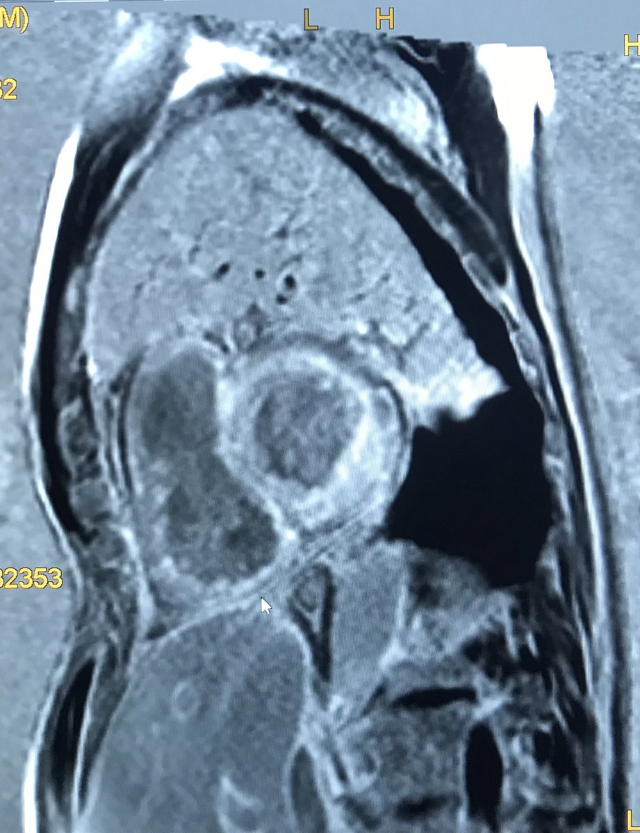 GrublerMartin's tweet photo. 74y/o male diagnosed with #HFpEF 3 y ago

#DPD #spect was scheduled after severe progr LVH became obvious. 

The #CMR LGE PSIR has all the hallmarks of cardiac #amyloidosis ECV>50%

I wonder why we wait so long to look for amyloid in older adults with HFpEF…

#WhyCMR #CMRfirst https://t.co/Nb3CjUr4bj