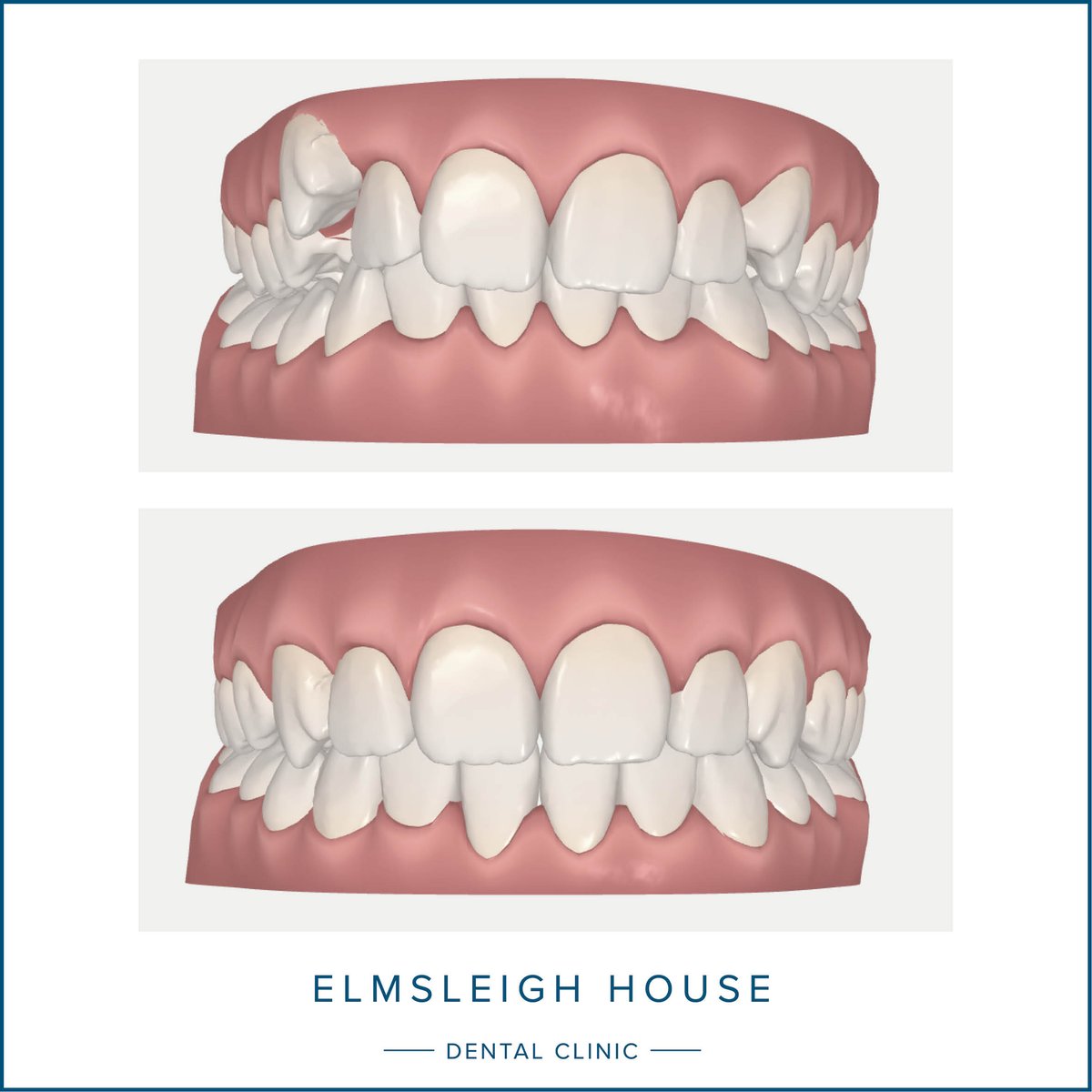 ElmsleighDental's tweet photo. Our specialist orthodontist #KostasSpathoulas uses 3D scans to plan clear aligner treatment to fix overcrowded teeth, widely spaced teeth, crossbites, overbites and underbites, often in 6–18 months. 

https://t.co/nSTPWILMMN

#AngelAligners #InvisalignClearAligners #SparkAligners https://t.co/AoEe89SfqB