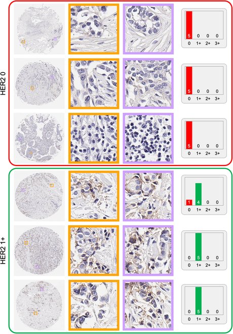 BMEF11's tweet photo. Automated HER2 scoring with deep learning: 84.7% accuracy, enhancing Breast Cancer diagnostics. New Article from BMEF: Automated HER2 Scoring in Breast Cancer Images Using Deep Learning and Pyramid Sampling. @SPJournals #HER2 #DeepLearning https://t.co/PGablkv199 https://t.co/rs36fstdSH