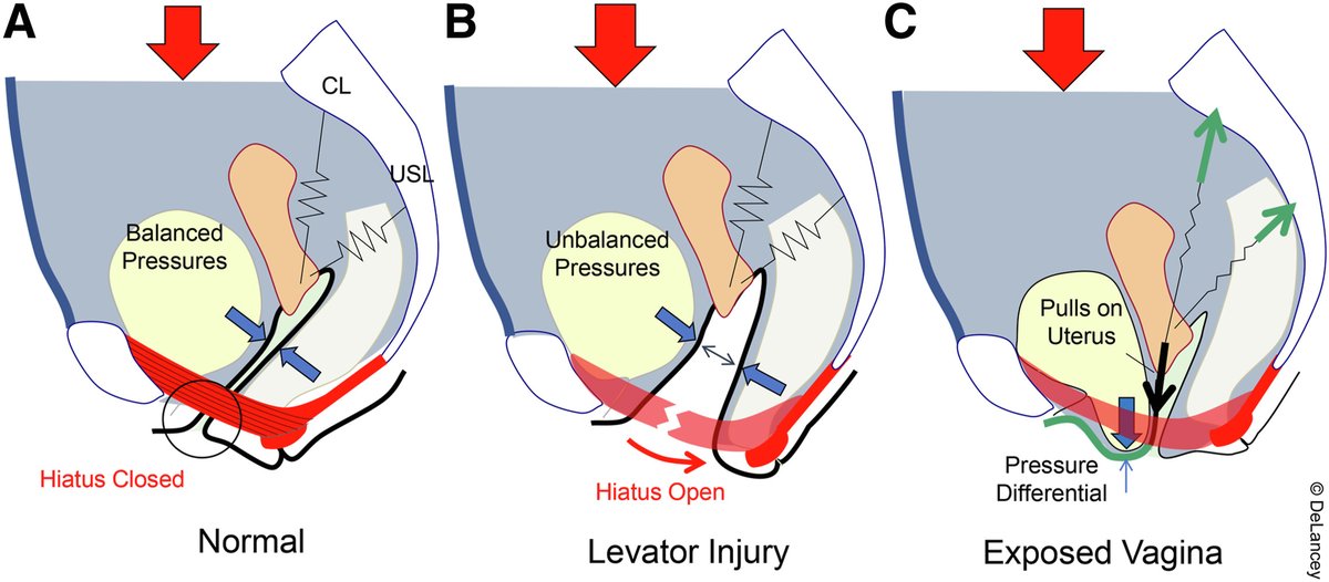 AJOG Expert Review:  Pelvic floor injury during vaginal birth is life-altering and preventable: what can we do about it? - Interactions among levator, anterior wall, and apical ligaments ajog.org/article/S0002-…