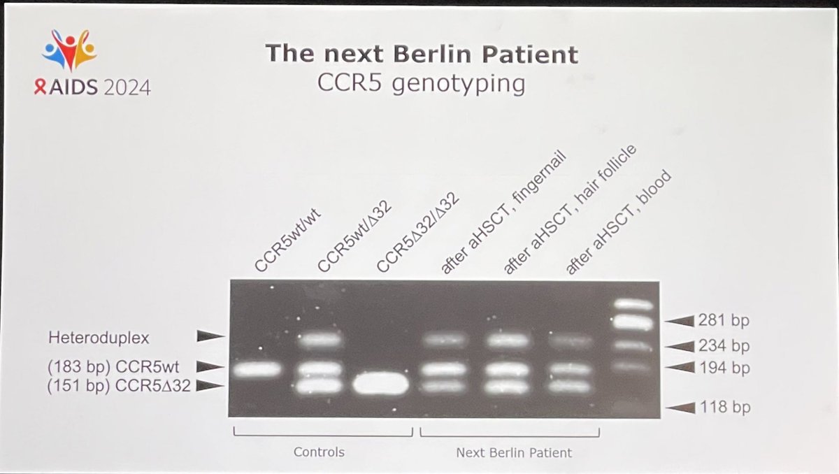 JezMex's tweet photo. En las opciones del Co-chair en #AIDS2024 inicia con el nuevo paciente Berlin. Un hombre nacido en 1964 que adquiere VIH en 2009. Inicia TAR en 2015 y se diagnostica LMA. Trasp autologo fr células madre hem heterocigoto a mut delta32  CCR5 + 1/ https://t.co/eBSZA649L4