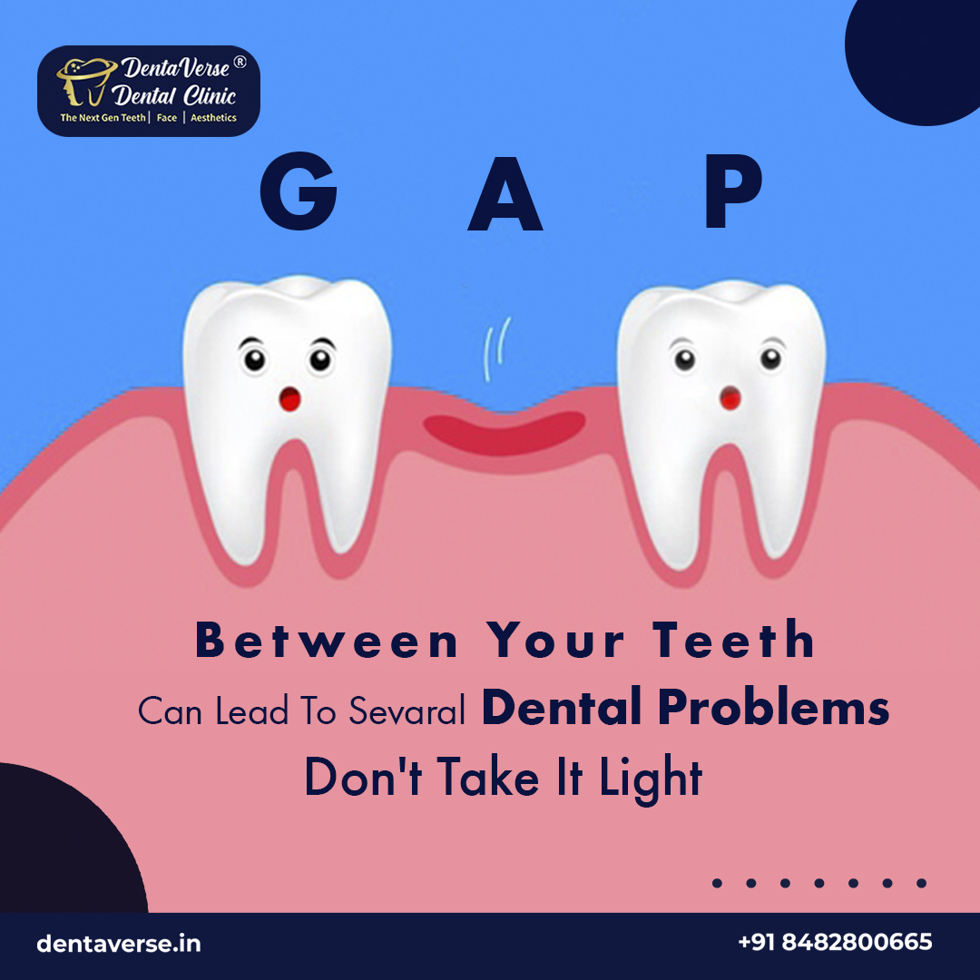 DentaverseD's tweet image. Ignoring the gap between your teeth can cause serious dental issues. Take action to   avoid future problems.
#DentaVerseDentalClinic   #teethgap #teethgap #dentist #dentalcare #braces #teethwhite #teethless   #teething #teethsmile #teethtrainer #teeth