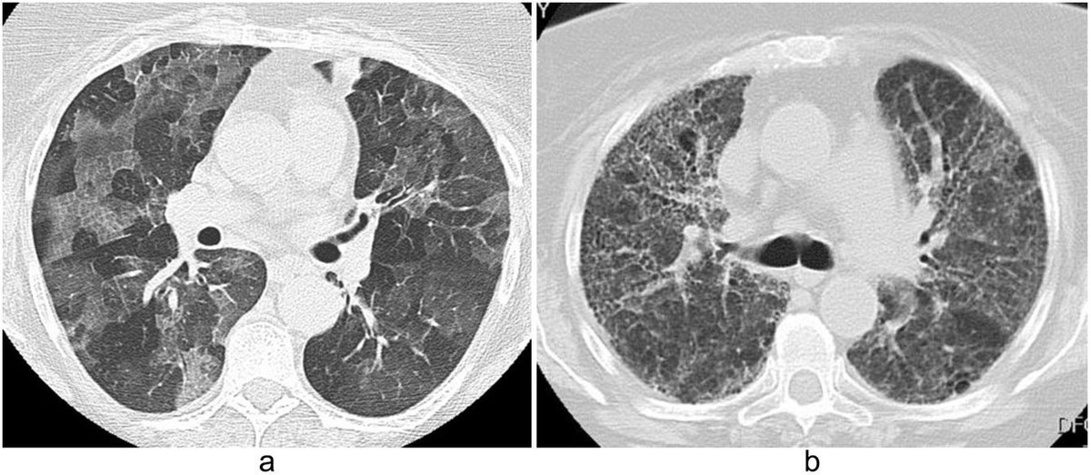 SERAM - Sociedad Española de Radiología Médica (@seram_rx) on Twitter photo Las enfermedades inhalatorias son un grupo de entidades secundarias a la aspiración activa de partículas
📙 Descubre sus claves diagnósticas en este artículo de la <a href="/RevistaRADIOLO2/">@RevistaRADIOLOGIA</a> 🔗 buff.ly/46mRge3
Link to the english version 🔗 buff.ly/4bZk2CT Las enfermedades inhalatorias son un grupo de entidades secundarias a la aspiración activa de partículas
📙 Descubre sus claves diagnósticas en este artículo de la <a href="/RevistaRADIOLO2/">@RevistaRADIOLOGIA</a> 🔗 buff.ly/46mRge3
Link to the english version 🔗 buff.ly/4bZk2CT