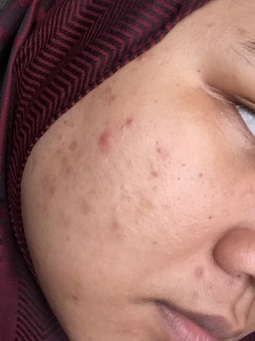 secretlyfura's tweet photo. let me guide you, on how to treat your darkspots!!! 

from this >>>>>>> to this https://t.co/EXUeePke2l