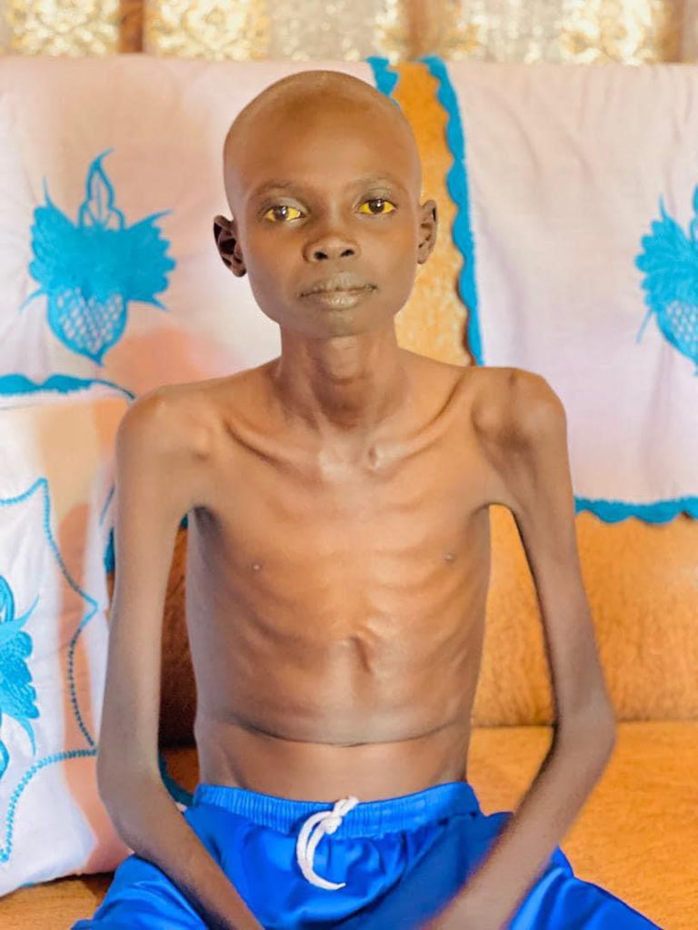 ms_ador22's tweet photo. Urgent Notice 🚨
Support Needed for 16-Year-Old Boy with Heart Disease

A 16-year-old boy named Reng Noi Ajoung in Hai Referendum, Juba South Sudan  is battling a severe heart disease that started in 2022 after several checkups and treatment,

https://t.co/k9zoiP6VhR https://t.co/AEh8ChBUJQ