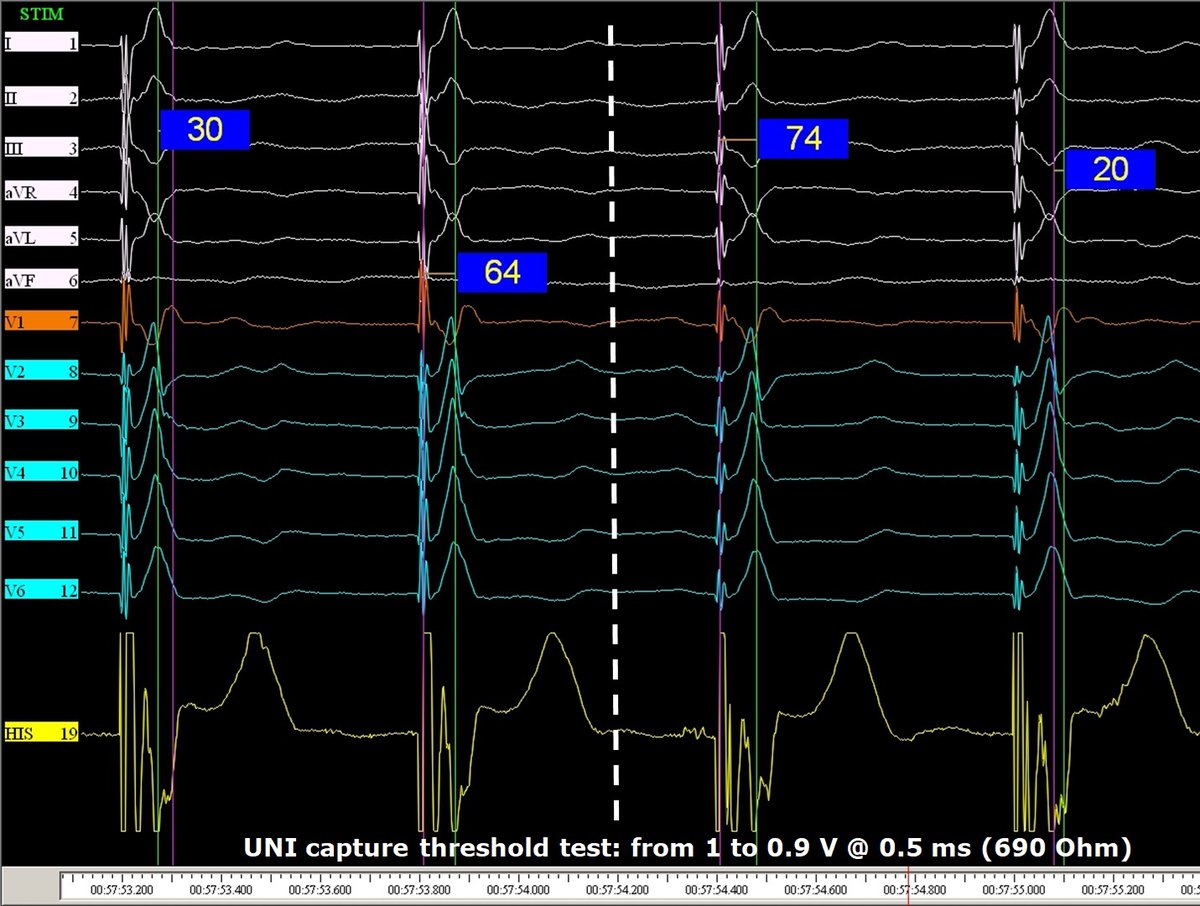 Giovanni Coluccia (@messapus) on Twitter photo #LBBAP in 81M w/syncope & parox adv AVB. #Epeeps, the only consistent reproducible variation on threshold test was this👇(minimal changes in EGM, ECG and V6RWPT): would you consider it a real transition (nsLBB>LVS?) or what..? <a href="/ZanonFrancesco/">Francesco Zanon</a> <a href="/Marek_Jastrz_EP/">Marek Jastrzębski</a> <a href="/OCanoPerez/">Óscar Cano</a> <a href="/MdHuang/">Weijian Huang</a> #LBBAP in 81M w/syncope & parox adv AVB. #Epeeps, the only consistent reproducible variation on threshold test was this👇(minimal changes in EGM, ECG and V6RWPT): would you consider it a real transition (nsLBB>LVS?) or what..? <a href="/ZanonFrancesco/">Francesco Zanon</a> <a href="/Marek_Jastrz_EP/">Marek Jastrzębski</a> <a href="/OCanoPerez/">Óscar Cano</a> <a href="/MdHuang/">Weijian Huang</a>