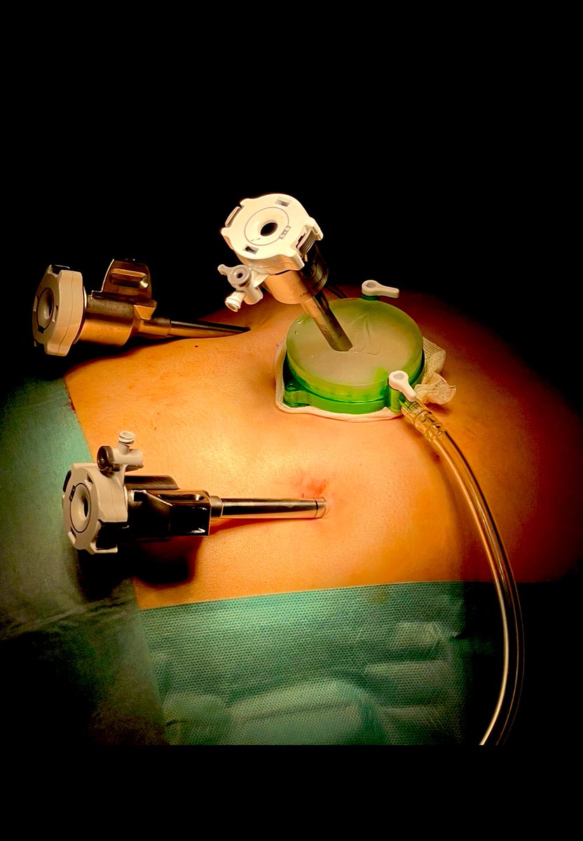 JoSeitlinger's tweet photo. Hey Twitter,

The Thoracic Surgery Department is actively seeking a thoracic surgical resident for 6 months up to 1 year starting November 1st 2024.

Annualy we perform over 950 cases. Futhermore, we are at the forefront of adopting novel minimally invasive and robotic approaches https://t.co/gYeEHbMEGk