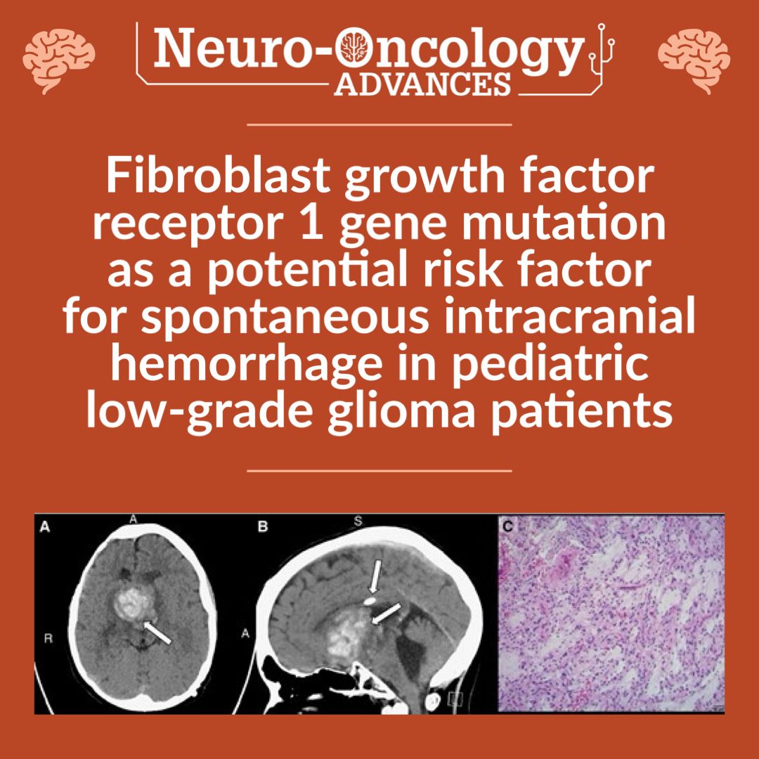 EditorNeuro's tweet image. What is the link between the FGFR1 #mutation and spontaneous #intracranial hemorrhage in #pediatric #LGGs? 

Read now: bit.ly/3WlciVM