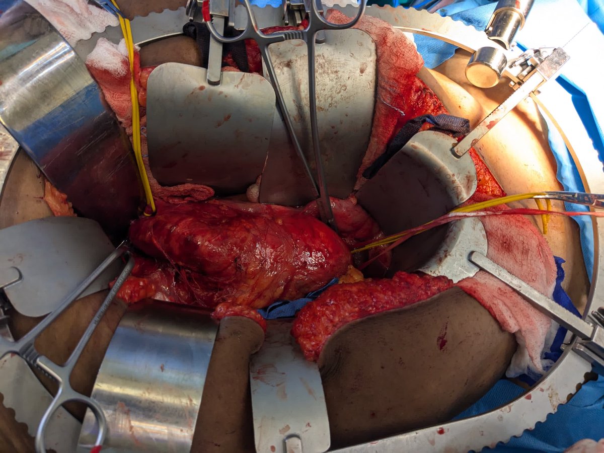 Girma Tefera MD,FACS (@gttefera) on Twitter photo Vascular surgery in Rwanda! Training Partnership between <a href="/AmCollSurgeons/">American College of Surgeons</a> and <a href="/kfaisalhospital/">King Faisal Hospital Rwanda</a> to learn more facs.org/for-medical-pr… <a href="/miranda_melone/">Miranda Melone</a> <a href="/msutherlandmd/">Michael Sutherland</a> <a href="/pturnermd/">Patricia L. Turner, MD, MBA, FACS</a> <a href="/DrSenait/">Professor Senait Fisseha</a> <a href="/VascularSVS/">Vascular SVS</a> <a href="/cosecsa/">COSECSA</a> Vascular surgery in Rwanda! Training Partnership between <a href="/AmCollSurgeons/">American College of Surgeons</a> and <a href="/kfaisalhospital/">King Faisal Hospital Rwanda</a> to learn more facs.org/for-medical-pr… <a href="/miranda_melone/">Miranda Melone</a> <a href="/msutherlandmd/">Michael Sutherland</a> <a href="/pturnermd/">Patricia L. Turner, MD, MBA, FACS</a> <a href="/DrSenait/">Professor Senait Fisseha</a> <a href="/VascularSVS/">Vascular SVS</a> <a href="/cosecsa/">COSECSA</a> 