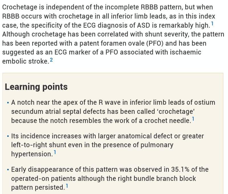 🔴 CROCHETAGE SIGN

🔹Crochetage sign in ASD was described by Heller J et al in 1996. It is a notch near the apex of the R wave (in the downstroke or upstroke ) in inferior leads. It has been called ‘crochetage’ because the notch resembles the work of a crochet needle.