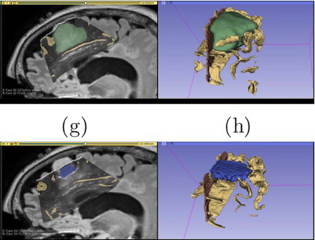 Xiao (@xiaobird) on Twitter photo We just added intra-op ultrasound anatomical segmentation for our RESECT dataset (archive.norstore.no/pages/public/d…) for brain tumor resection! 🧠 For more info about the dataset, check out our new article: aapm.onlinelibrary.wiley.com/doi/10.1002/mp… <a href="/HassanRivaz/">Hassan Rivaz</a> <a href="/ingerid_r/">Ingerid Reinertsen</a> Matthieu Chabanas We just added intra-op ultrasound anatomical segmentation for our RESECT dataset (archive.norstore.no/pages/public/d…) for brain tumor resection! 🧠 For more info about the dataset, check out our new article: aapm.onlinelibrary.wiley.com/doi/10.1002/mp… <a href="/HassanRivaz/">Hassan Rivaz</a> <a href="/ingerid_r/">Ingerid Reinertsen</a> Matthieu Chabanas
