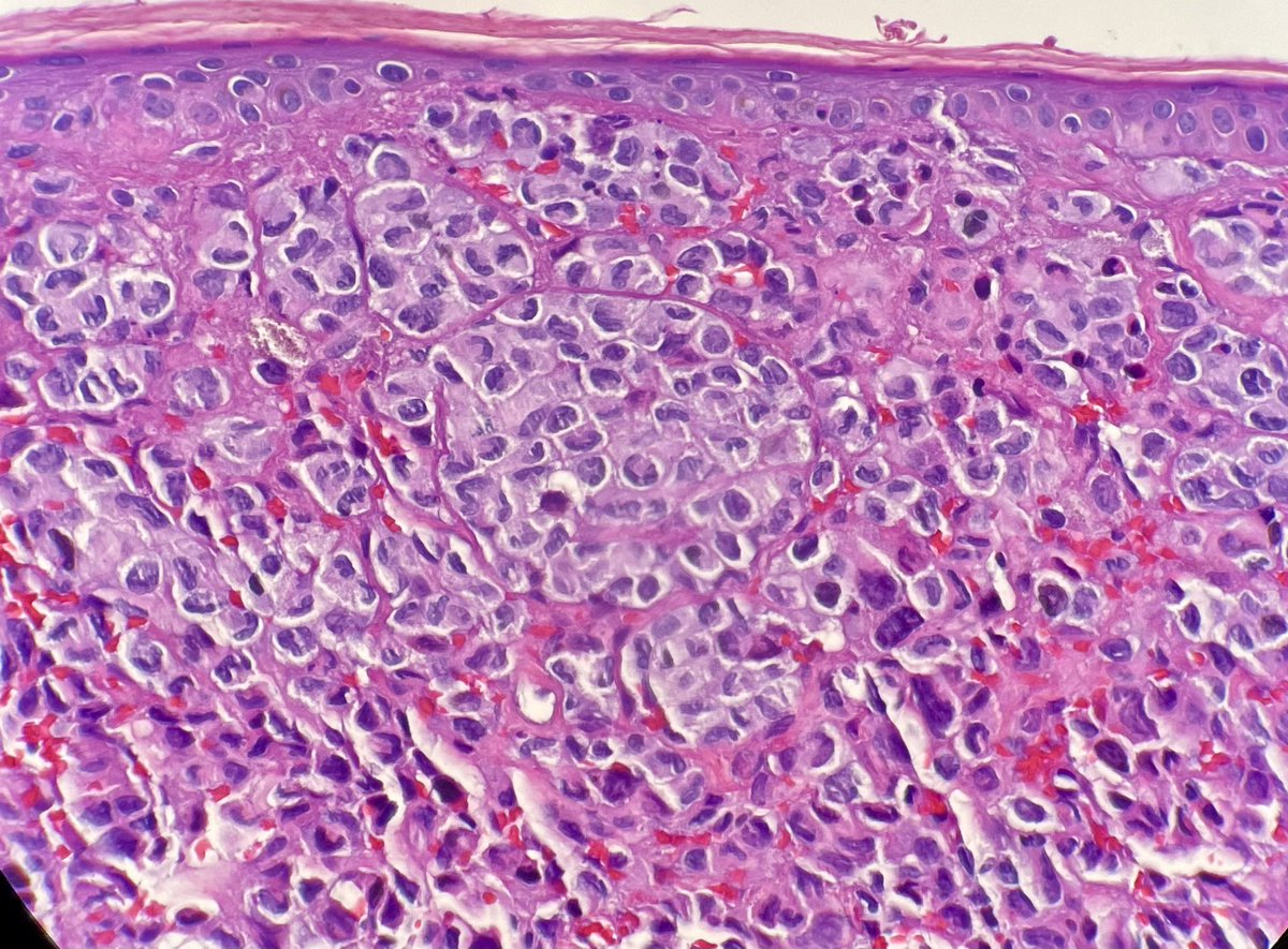 Someone smell the coffee bean nuclei of Langerhan’s cells ? #derm #dermpath