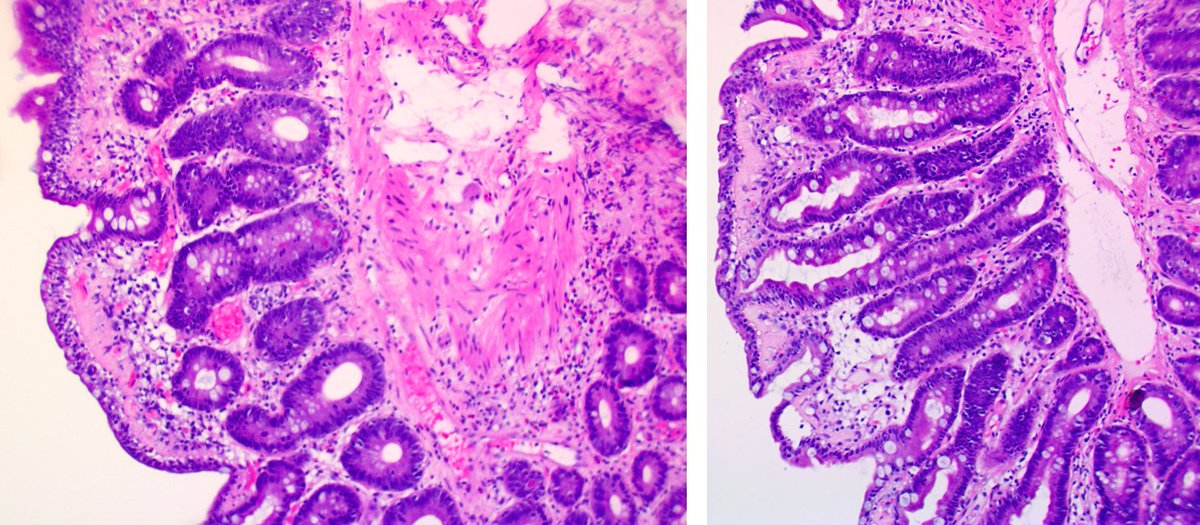 A case of collagenous sprue. #pathology #GIpath