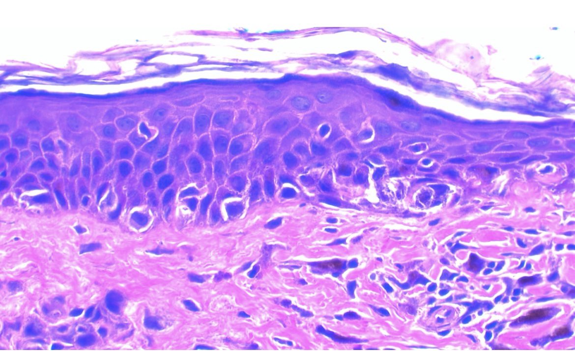 JCandidoXavier's tweet photo. Traumatized nevus can show junctional atypical cells. 😐🧐🤓
See the superficial dermal fibrosis and pigment incontinence. 👀👁️
#nevus #skin #cancer #medicine #pathology #dermatology https://t.co/Z8OOAZhHLI