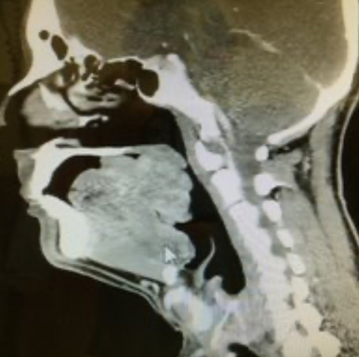 AirwayLegend's tweet photo. Airway mx can be a challenge 

If you don’t have immediate ENT backup, learn/practice/use what ENTs use to deal with complex scenarios

This method can avoid crics &amp; can be used anywhere including prehospital 

#airway #viescope #patientsafety https://t.co/ep51N81fDz