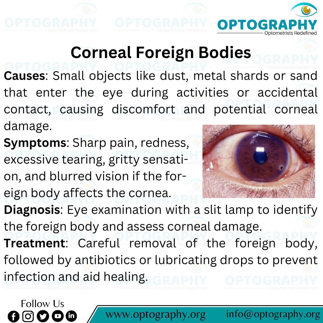 Optography8's tweet photo. #Cornealforeignbody #Cornea
#Optometry #Foreignbody
#Optography #Protectiveeyewear
#Cornealprotection https://t.co/KXZVPxCt2Q
