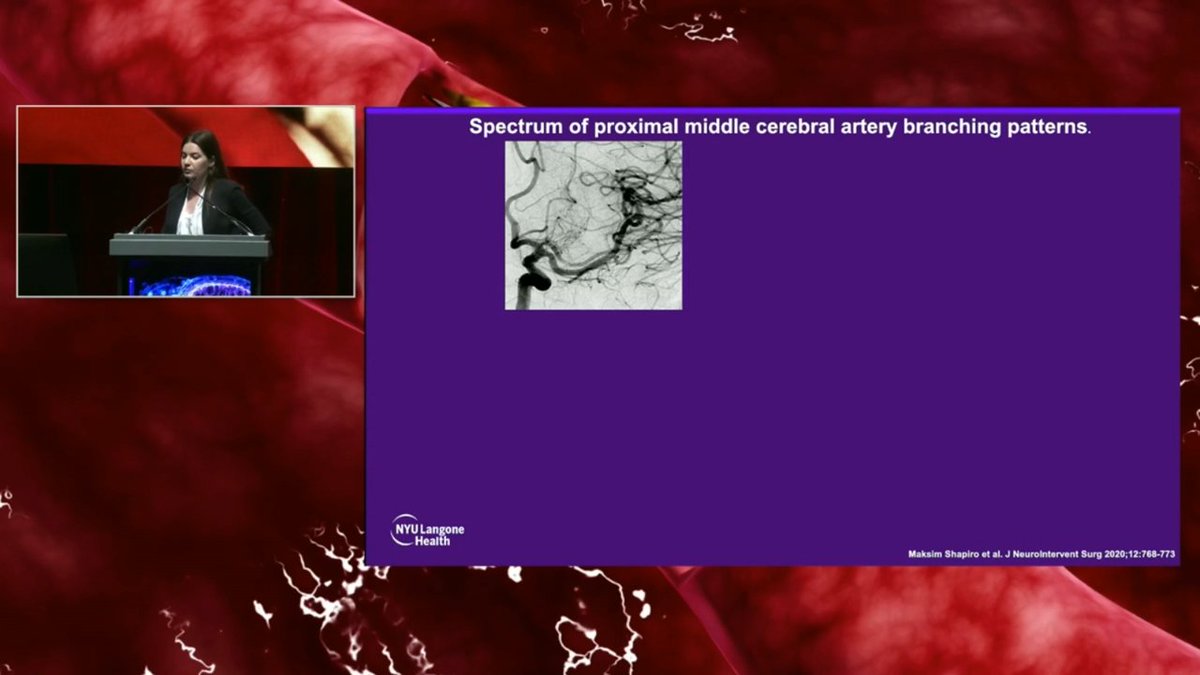 JNIS (@jnis_bmj) on Twitter photo Thrombectomy: Where, When, & How. <a href="/SharashidzeVera/">Vera Sharashidze</a> shows how to master the anatomic maze for thrombectomy in medium and distal occlusions! #SNIS2024 @SNISInfo <a href="/cvsection/">CV Section</a> @cfalbuquerque51 <a href="/CruzCerebri/">Aurora S. Cruz</a> @mariapanrad <a href="/DanniDiestro/">Dr. DiestroKE</a> <a href="/MattAmansMD/">Matthew Amans</a> <a href="/ducruetaf/">Andrew Ducruet</a> <a href="/MattFusco_MD/">Matt Fusco</a> <a href="/DrAltschul/">Dorothea Altschul MD FAHA FSVIN</a> Thrombectomy: Where, When, & How. <a href="/SharashidzeVera/">Vera Sharashidze</a> shows how to master the anatomic maze for thrombectomy in medium and distal occlusions! #SNIS2024 @SNISInfo <a href="/cvsection/">CV Section</a> @cfalbuquerque51 <a href="/CruzCerebri/">Aurora S. Cruz</a> @mariapanrad <a href="/DanniDiestro/">Dr. DiestroKE</a> <a href="/MattAmansMD/">Matthew Amans</a> <a href="/ducruetaf/">Andrew Ducruet</a> <a href="/MattFusco_MD/">Matt Fusco</a> <a href="/DrAltschul/">Dorothea Altschul MD FAHA FSVIN</a>