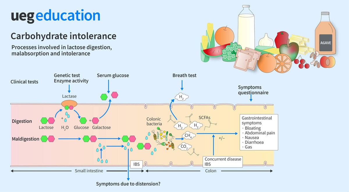 Mistakes in the diagnosis and management of carbohydrate intolerances 🍞 🥛 🍎 

#MedTwitter #GITwitter #diet #nutrition 

ueg.eu/a/150?fbclid=I…