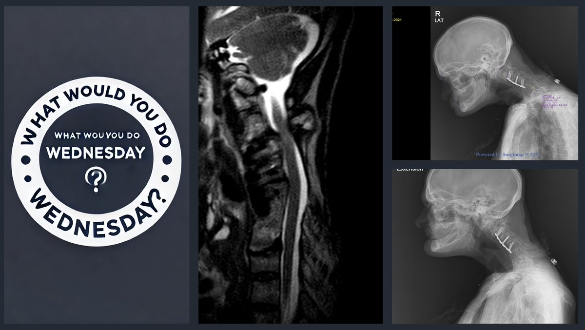AANS/CNS Spine Section (@spinesection) on Twitter photo 57 y/o male with history of multiple prior ACDFs and a C3-C5 laminectomy who presents with neck pain, a chin-on-chest deformity, progressive myelopathy.
What would you do?
1) Posterior / anterior / posterior surgery?
2) Anterior only?
3) Posterior only?
<a href="/CheeragU/">Cheerag Upadhyaya, MD, MBA, MSc, FAANS, FACS</a> <a href="/andrewchanMD/">Andrew Chan, MD</a> 57 y/o male with history of multiple prior ACDFs and a C3-C5 laminectomy who presents with neck pain, a chin-on-chest deformity, progressive myelopathy.
What would you do?
1) Posterior / anterior / posterior surgery?
2) Anterior only?
3) Posterior only?
<a href="/CheeragU/">Cheerag Upadhyaya, MD, MBA, MSc, FAANS, FACS</a> <a href="/andrewchanMD/">Andrew Chan, MD</a>