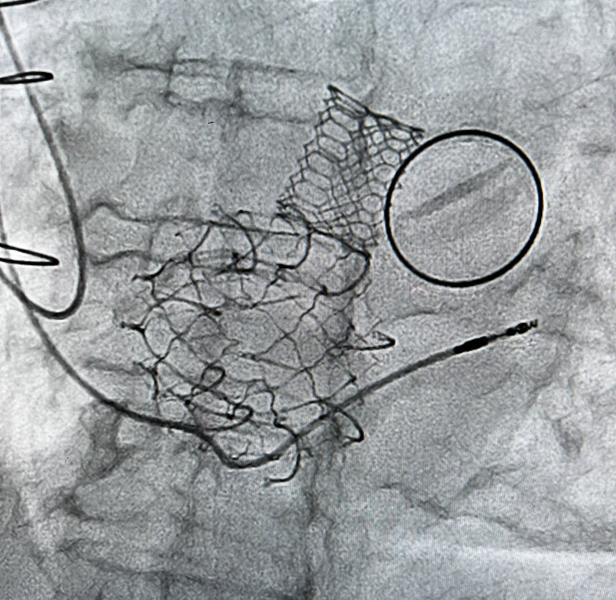 Abhijeet Dhoble (@dhoble7) on Twitter photo Bionic Heart ! Great results with <a href="/EdwardsLifesci/">Edwards Lifesciences</a> Evoque in spite of imaging difficulties <a href="/DrDeepa1020/">Deepa</a> <a href="/memorialhermann/">Memorial Hermann</a> <a href="/UTHealthHouston/">UTHealth Houston</a> <a href="/UTHeartVascular/">UTHealth Houston Heart & Vascular</a> Bionic Heart ! Great results with <a href="/EdwardsLifesci/">Edwards Lifesciences</a> Evoque in spite of imaging difficulties <a href="/DrDeepa1020/">Deepa</a> <a href="/memorialhermann/">Memorial Hermann</a> <a href="/UTHealthHouston/">UTHealth Houston</a> <a href="/UTHeartVascular/">UTHealth Houston Heart & Vascular</a>