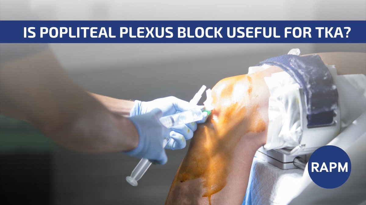 🔬 Curious findings in this RCT! 

💉 Combining a popliteal plexus block with a femoral triangle block reduced 24-hour opioid use post-TKA (Bupivacaine 0.5% was used). 

⚠️ No differences in pain, mobilization, or muscle function!!! 

🔗 Read more here: bit.ly/3y6Aaoe
