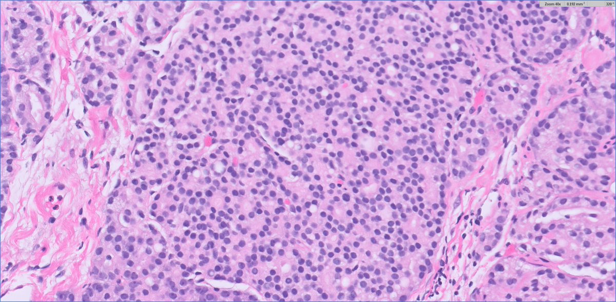 #grayzonepath #GUpath prostate bx🔬example:

4+4 vs 4+5? adding poll for fun but perhaps no right answer...⏬

some consider foci on the right (black box) as "solid rosette-like" pattern 5, in contrast to pattern 4 with true lumens (left yellow box)