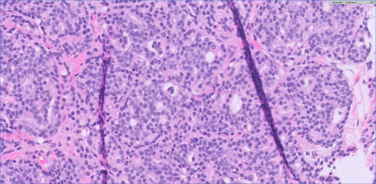 slusagar's tweet photo. #grayzonepath #GUpath prostate bx🔬example:
4+4 vs 4+5? adding poll for fun but perhaps no right answer...⏬
some consider foci on the right (black box) as "solid rosette-like" pattern 5, in contrast to pattern 4 with true lumens (left yellow box) https://t.co/Uj7apWCL6Z