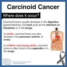 A well-differentiated neuroendocrine tumor, or carcinoid tumor, can sometimes cause carcinoid syndrome, a rare condition affecting fewer than 10% of patients. These tumors typically originate in the gastrointestinal tract or lungs