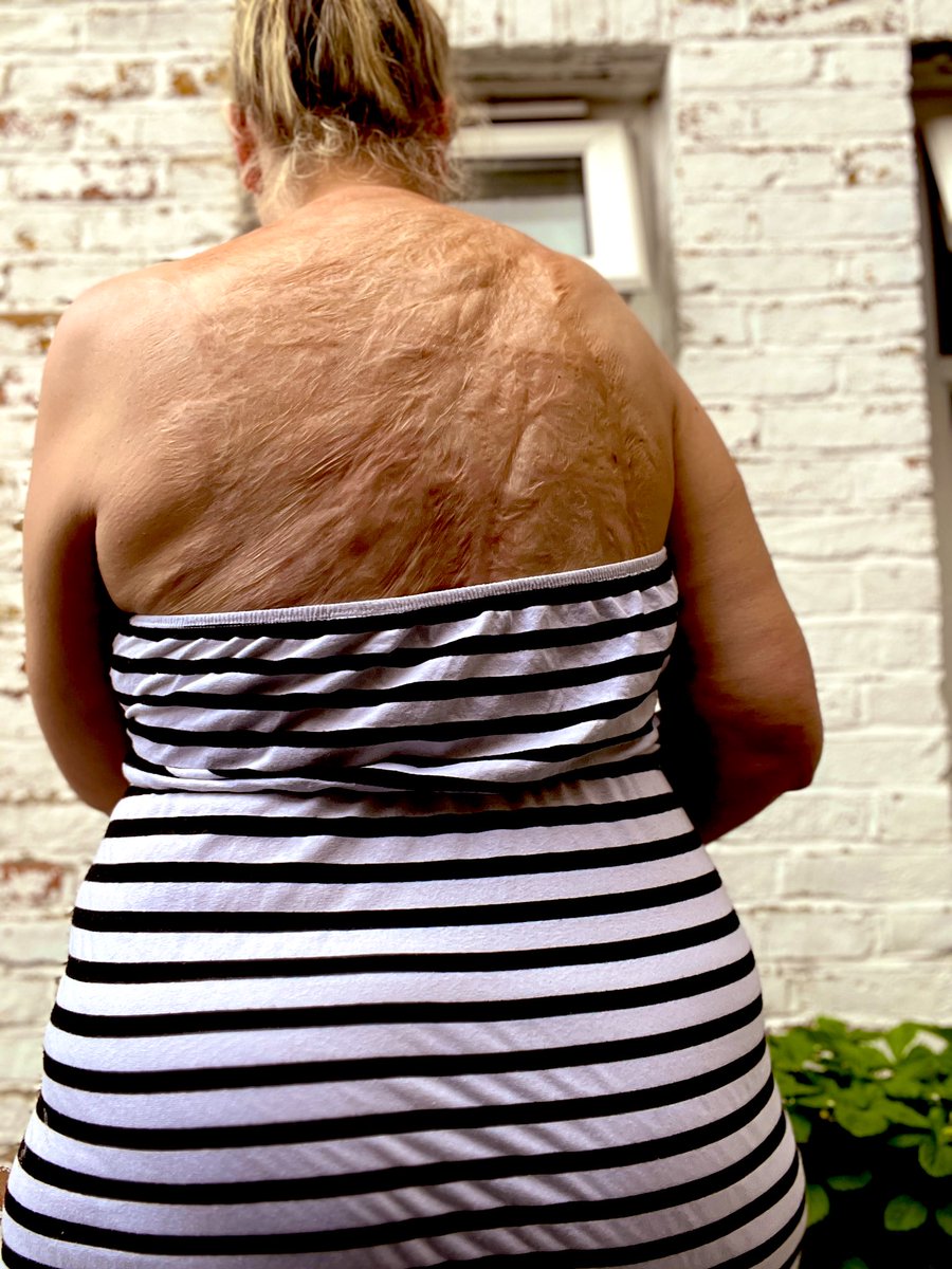 Next time you watch a #film &amp; see a ‘Scarred Baddie’ spare a thought for children that are badly burned &amp; how they must hurt. How Amazing it would be to watch a film with #diversity &amp; #Inclusion the person with Scars as the ‘Goody’! Everyone preaches Diversity but I’m not so sure