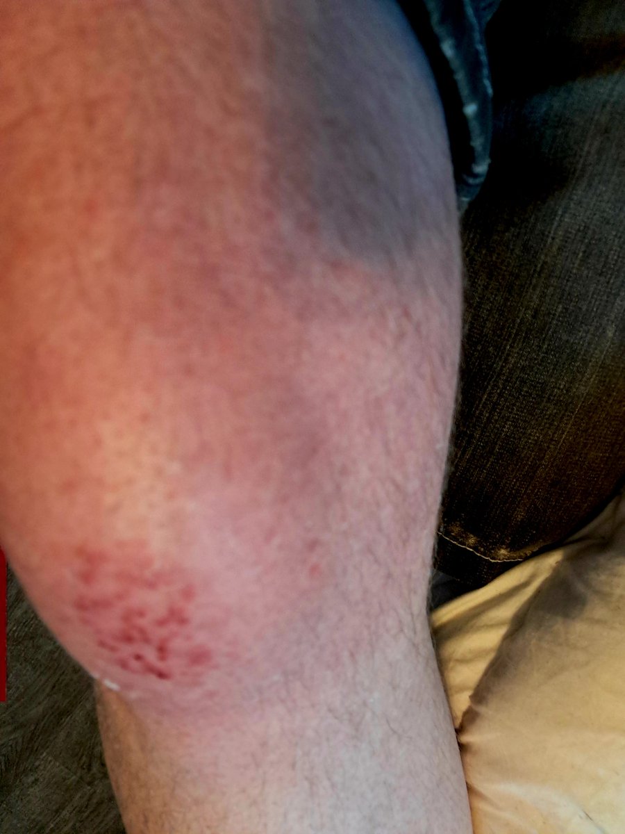 F*cking jerk looking down at their phone in a Lincoln Navigator veered in to the bike lane and almost killed me. #Thanks #Minneapolis!  #Texting while driving should be a felony for real that's my KNEE!