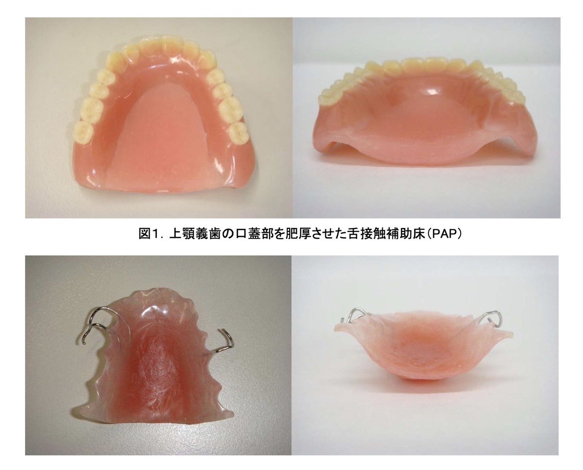 shika_hoken's tweet photo. 低下症＋舌圧検査＝PAP

これで

・舌圧検査140点が月2回
・歯リハ1 194点が月4回

算定できるようになる

舌圧測定器が売り切れるのも納得やな

https://t.co/mY3z0S19Ta https://t.co/Lbc99cI0dG