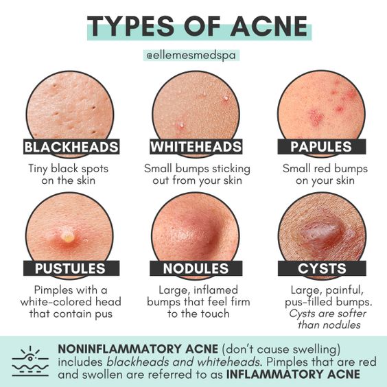 Mens_Talk2024's tweet photo. Jerawat Lagi? Kenali Dulu Kandungan Skincare Sesuai Dengan Jenisnya!

—a thread ⏬ https://t.co/e8FtDwbDxE