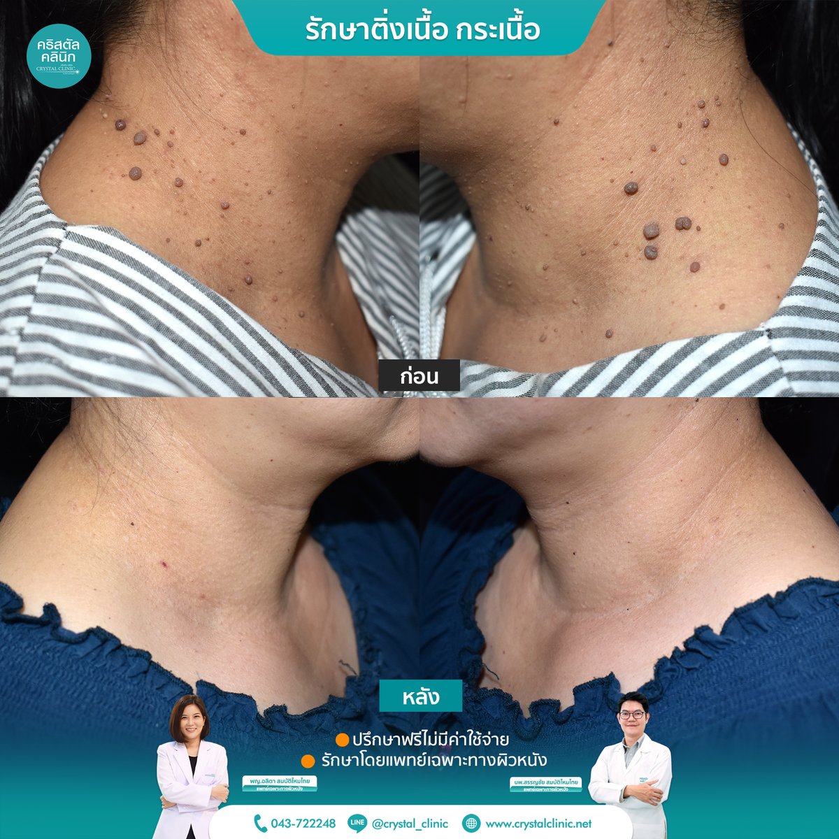 Crystalclinic_m's tweet image. กำจัดกระเนื้อ ติ่งเนื้อ ด้วยเลเซอร์ โดยแพทย์เฉพาะทางผิวหนัง กับ คริสตัลคลินิก มหาสารคาม

#CO2Laser #กำจัดกระเนื้อ #คลินิกรักษาโรคผิวหนังมหาสารคาม #crystalclinic #คริสตัลคลินิก #ติ่งเนื้อ #กำจัดติ่งเนื้อมหาสารคาม #กำจัดกระเนื้อมหาสารคาม #กระเนื้อที่คอ #ติ่งเนื้อที่คอ