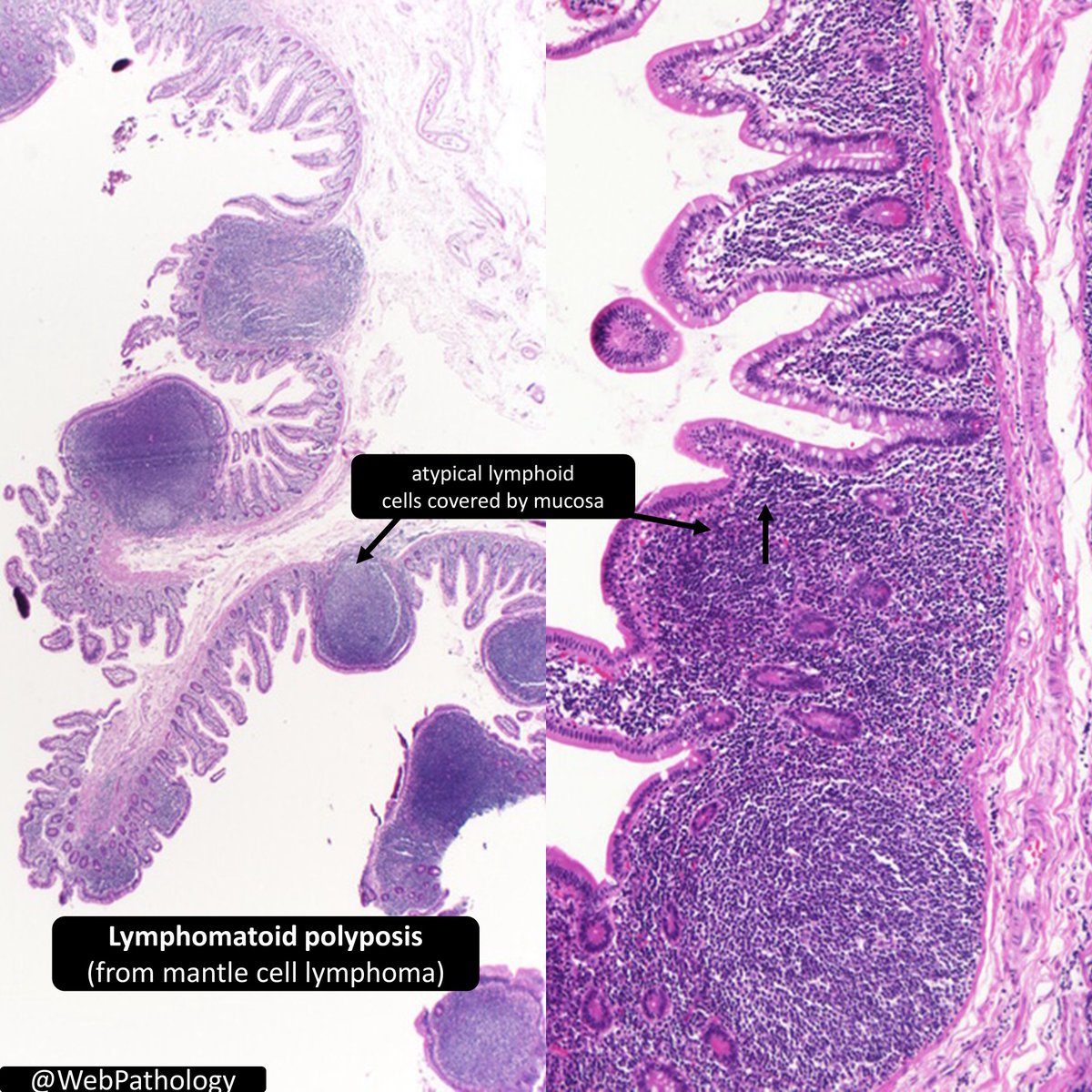 DrCycloPath's tweet photo. Lymphomatous polyposis
numerous polyps of atypical lymphoid cell aggregates present in colorectal lymphomas
✅mantle cell lymphoma is the most common 
✅t(11;14) CCND1::IGH
❌Follicular lymphoma t(14;18) IgH::MALT1 
❌MALToma
#HemePath #GIPath #PathTwitter #pathology