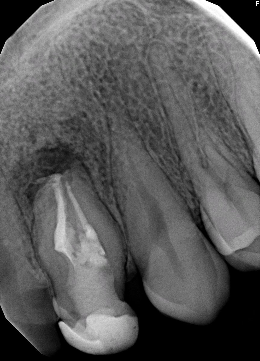 khalid_enezii's tweet photo. Today case is  developmental anomaly “Dens invaginatus “
- pulp stone removed 
- separated file retrieved  
- distal canal located 
A challenging case .. cases like this for sure needs follow up   
الحمدلله 🙏🏻 https://t.co/xGSyWG5aoI