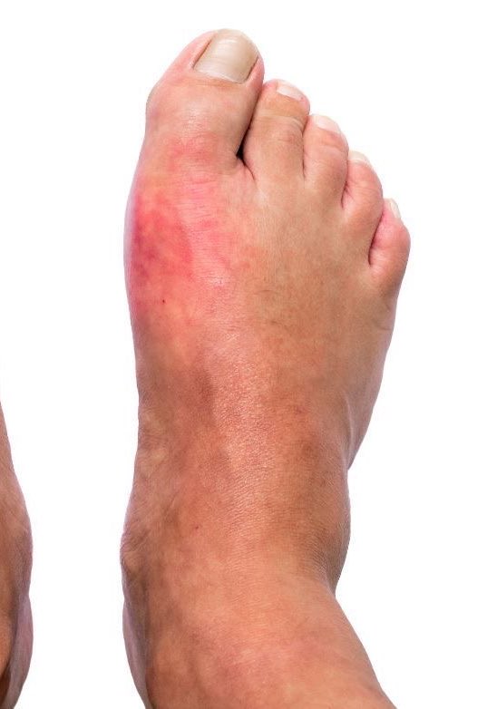 garer149's tweet image. أحذر أن تكثر من أكل اللحوم سيصيبك "داء الملوك"👑🚫

هذا المرض يعتبر أكثر الأمراض ألماً للمفاصل وأكثرهم إزعاجاً لصاحبه ⚠️

يسمونه "داء الملوك"  وستعرف السبب..

أسبابه.. أعراضه.. علاجه.. طرق الوقاية 👇👇